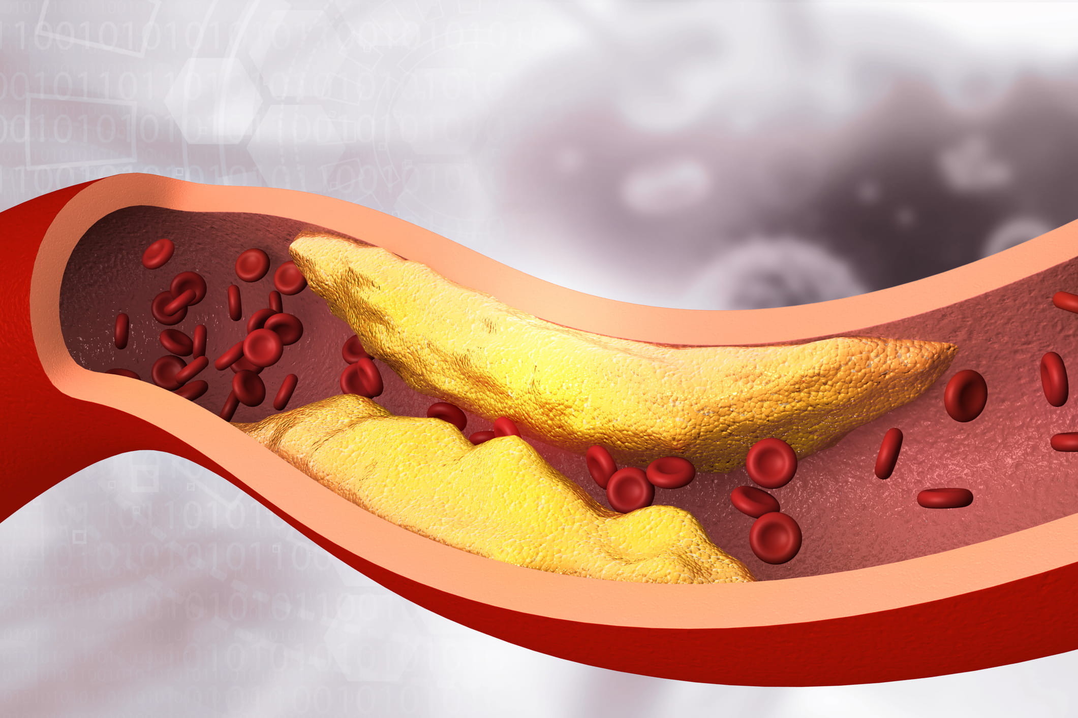 Coronary Calcium Score