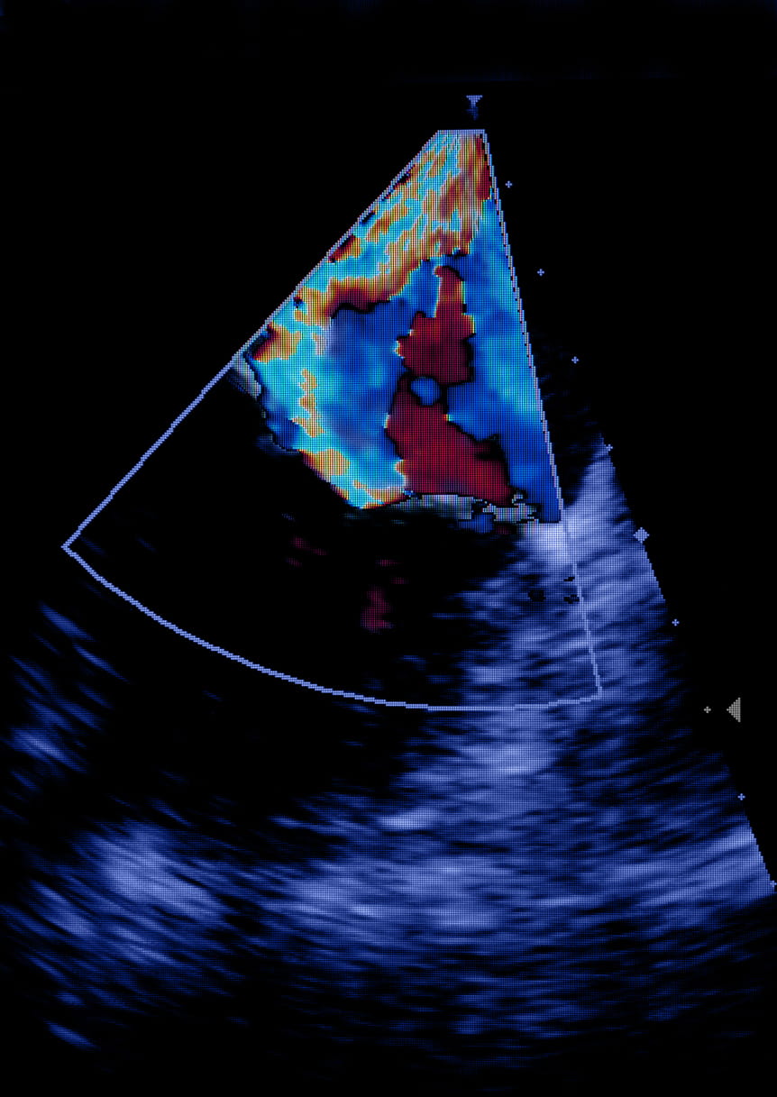 Screen of echocardiography (ultrasound) machine. 